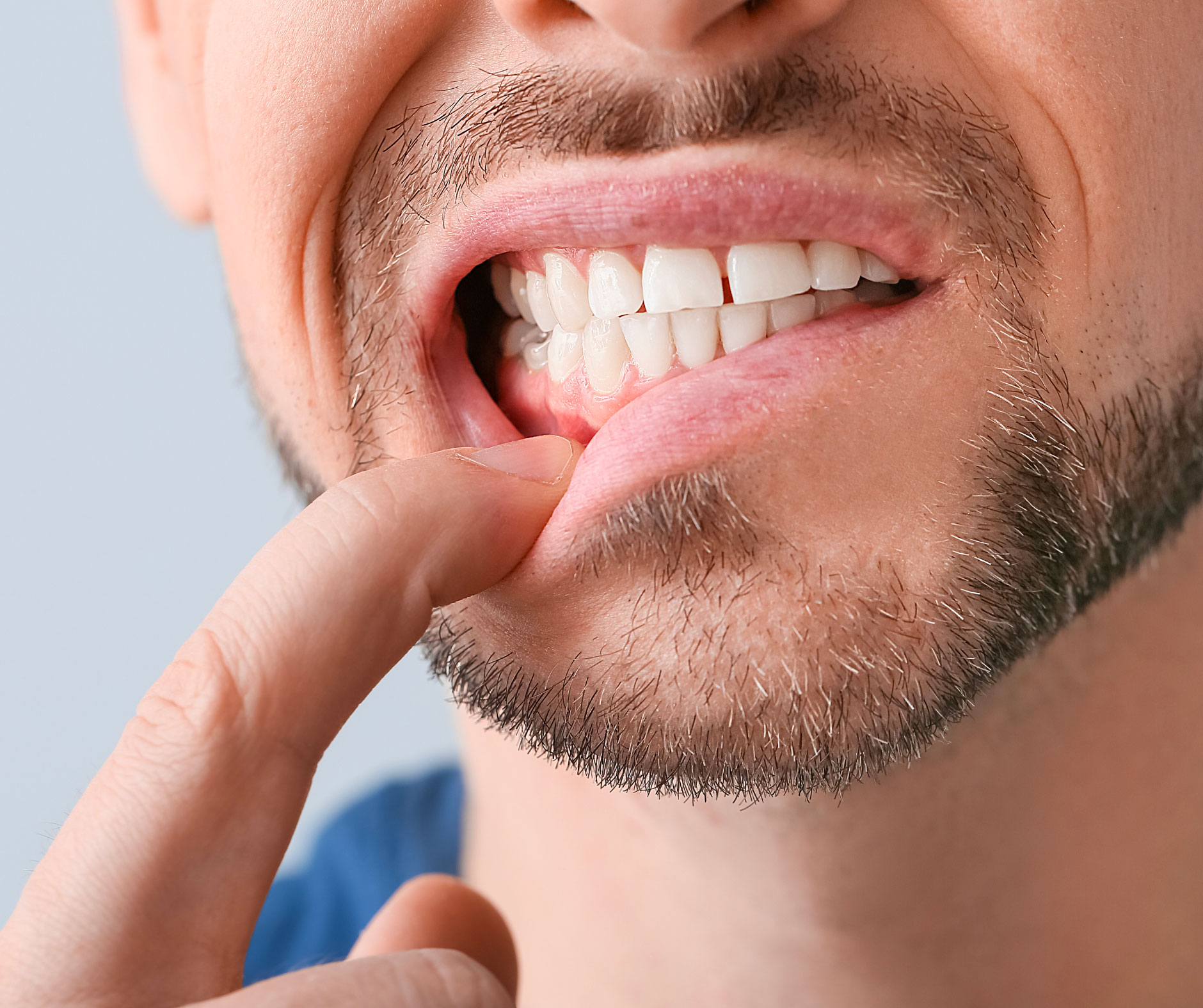 Sensibilità gengivale: cause e rimedi per combatterla